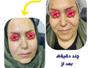 هایفوتراپی برای جوانسازی پوست