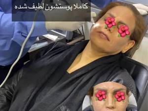 درمان سریع جای جوش در کرمانشاه