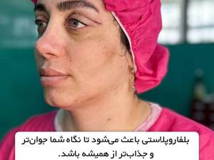هزینه عمل تخصصی بلفاروپلاستی در تهران