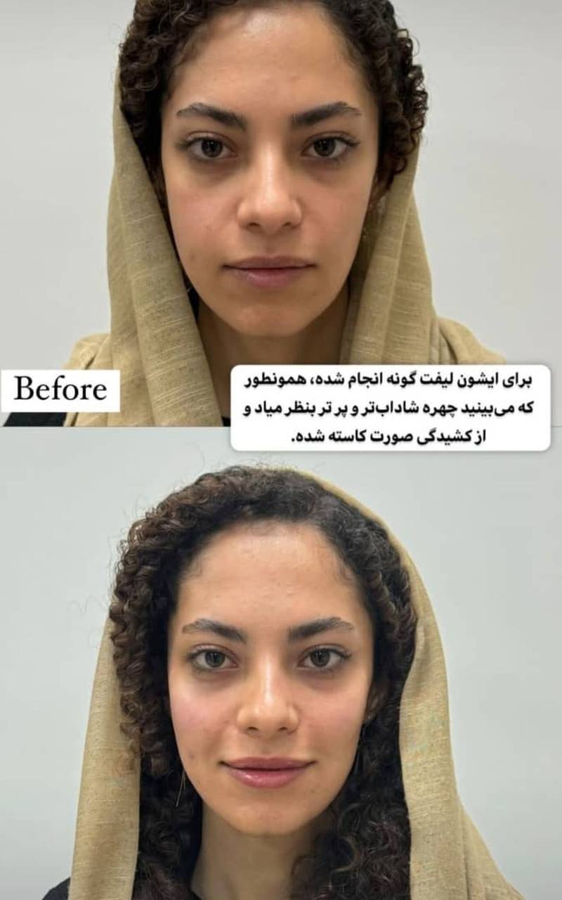 لیفت صورت در شریعتی تهران