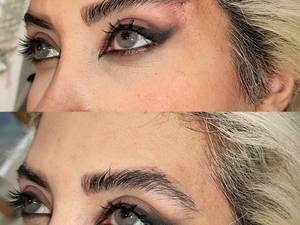 قیمت لیفت صورت با نخ در قائمشهر