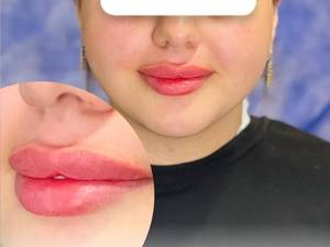 مزایای فیلر لب بهترین کلینیک تزریق فیلر در لاهیجان