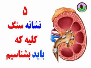 5 نشانه سنگ کلیه که باید بشناسیم
