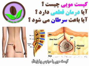کیست مویی یا سینوس پیلونیدال چیست ؟