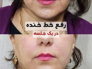 لیفت صورت بدون جراحی بوشهر