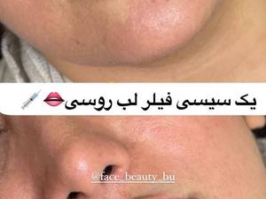 تزریق لب روسی طبیعی در بوشهر
