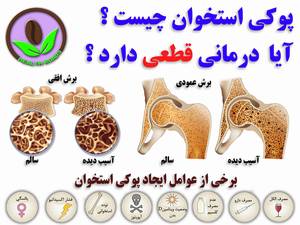 پوکی استخوان چیست ایا درمانی دارد ؟
