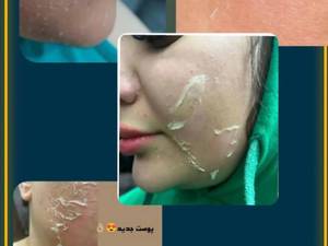 الگاپیل پوست مار لایه برداری عمیق در اهواز