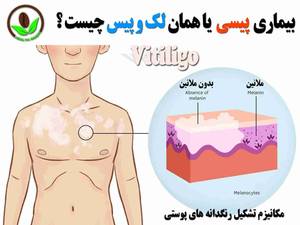 بیماری پیسی یا همان لک و پیس چیست ؟