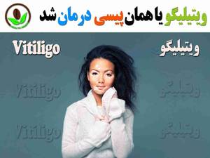 بیماری پیسی یا لک و پیس درمان شد