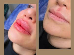 فیلر لب طبیعی در لاهیجان