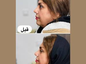 تزریق ژل چانه در رشت