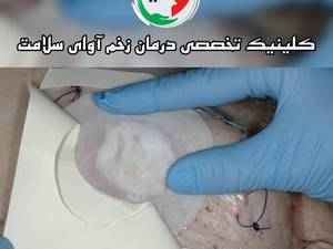 ماگوت تراپی در ساری