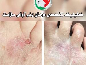 کربوکسی تراپی زخم در بابلسر