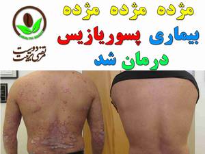بیماری پسوریازیس درمان شد