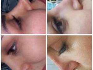 تزریق ژل و فرم‌دهی بینی با فیلر در کرمانشاه