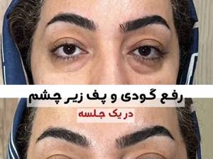 درمان گودی زیر چشم بدون جراحی در بوشهر