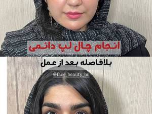 هزینه چال لپ دائمی بوشهر