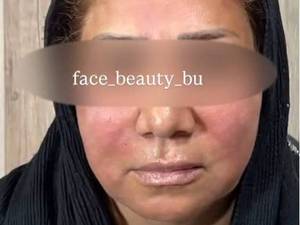 لیفت صورت بدون عمل در بوشهر