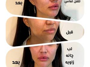 تزریق ژل برای فرم‌دهی گونه در تهران