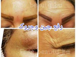 تزریق بوتاکس