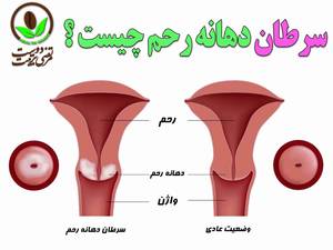 سرطان دهانه رحم چیست ؟