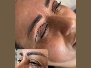 جراحی افتادگی پلک بالا در لاهیجان