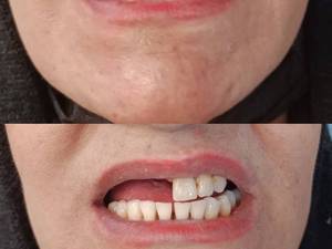 هزینه ساخت پارسیل دندان با لثه ژله ای در اصفهان