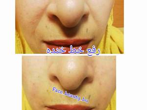 رفع خط خنده با تزریق ژل بابهترین برند وکیفیت