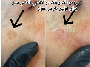 انجام تخصصی ریمو کک و مک در اهواز