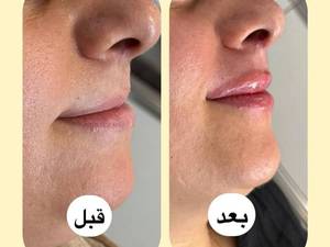 تزریق فیلر لب طبیعی در در لاهیجان