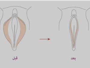 دکتر متخصص برای تنگی واژن در خرم اباد