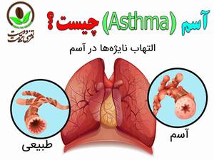 آسم  (  Asthma  ) چیست ؟