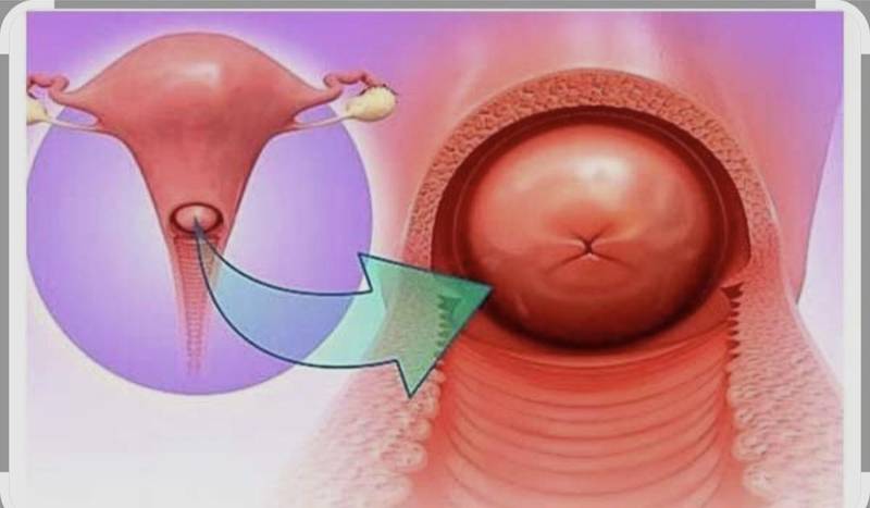 فریز دهانه رحم در خرم باد