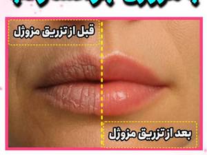 تزریق مزوژل جوان‌ساز لب در رشت