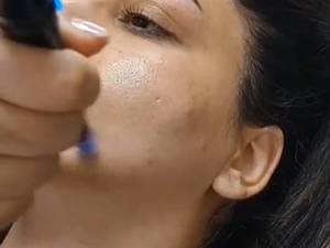 مزونیدلینگ برای درمان جای جوش در قزوین