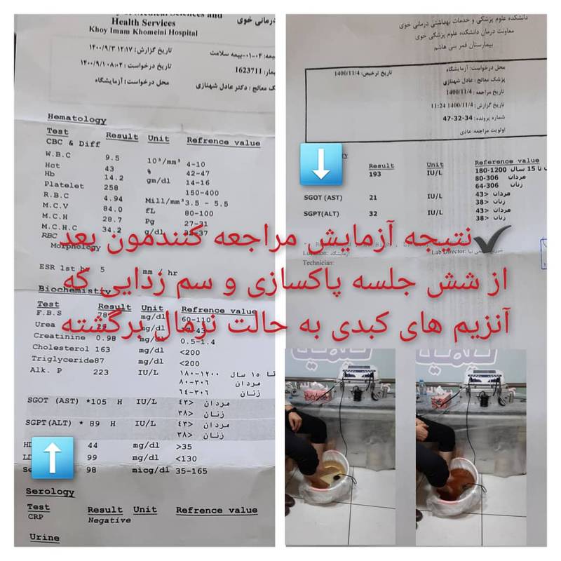 درمان صددرصد کبد چرب در خوی