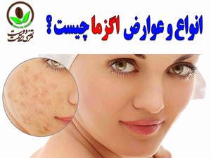 انواع و عوارض اگزما چیست ؟