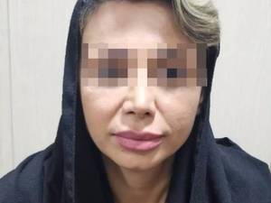 کلینیک لیفت گونه با نخ در بوشهر