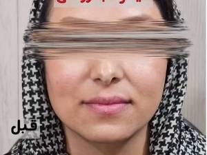 اصلاح فرم لب با فیلر روسی در بوشهر