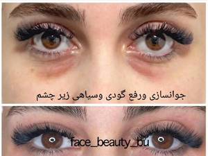 جوانسازی و رفع گودی چشم در بوشهر