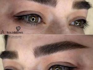 معرفی بهترین مرکز تخصصی فیبروز ابرو در تبریز