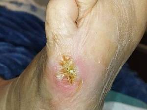 دکتر درمان زخم بستر در آمل