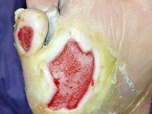 درمان زخم پای دیابتی نوروپاتیک در آمل