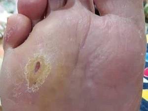 درمان زخم پای دیابتی نوروپاتیک در آمل