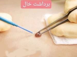 برداشت خال