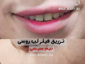 تزریق فیلر لب روسی در بوشهر