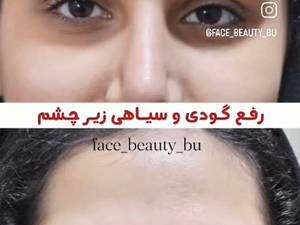 رفع گودی زیر چشم در بوشهر