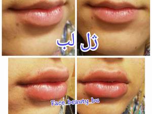 تزریق ژل لب