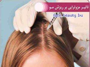 مزوتراپی موی سر